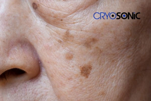 Protecting Your Skin from Sun Damage and Age Spots Gloucester