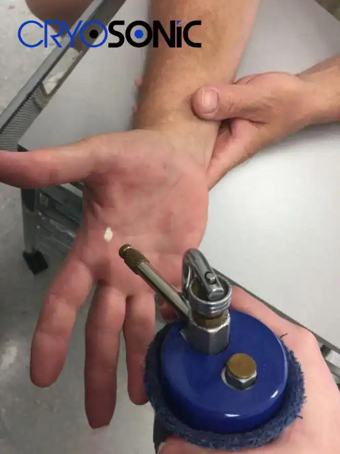 Temperature Differences: OTC vs Medical-Grade Cryotherapy Gloucester